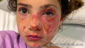Parents warned after toy leaves children badly burned