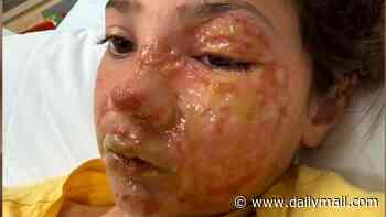 Father faces backlash after his daughter, 10, suffered horrific burns to her face when her viral squishy toy exploded