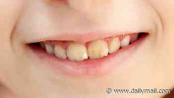 What's behind the alarming rise in a mystery dental condition that's leaving children's teeth discoloured and crumbling?