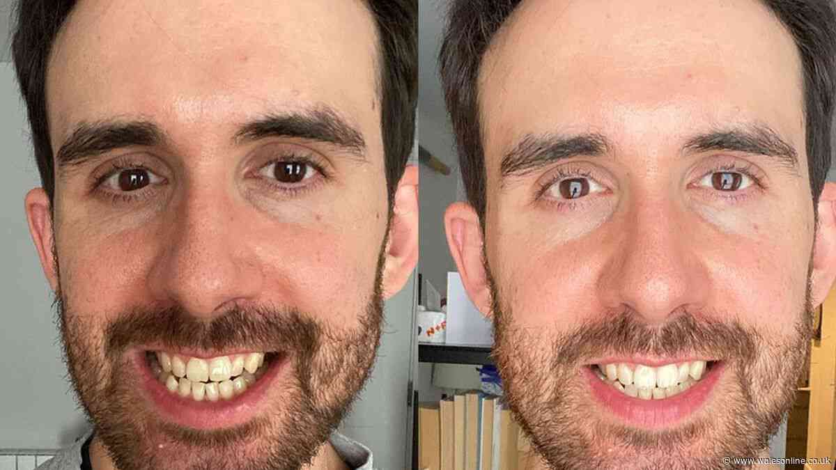 Coffee drinker's 'lifetime of stains' are 'all gone' with £10 teeth whitener