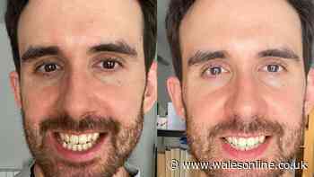 Coffee drinker's 'lifetime of stains' are 'all gone' with £10 teeth whitener