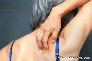 More evidence shows shingles vaccine protects against dementia. What’s really going on?