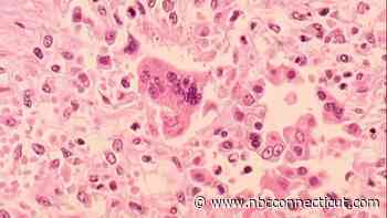 DPH confirms state's second measles case, first in a vaccinated adult