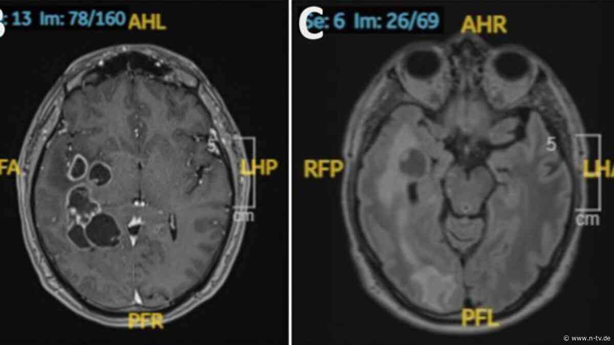 Ärzte vermuteten Tumor: Mann hat jahrelang Bandwürmer am Gehirn, ohne es zu merken