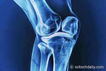 New Nonsurgical Knee Treatment Delivers Lasting Pain Relief