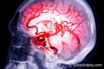 Scientists Discover Surprising Way To Help the Brain Recover After Stroke