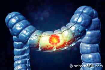 Surgeons Warn: Don’t Ignore These Colorectal Cancer Symptoms, No Matter Your Age