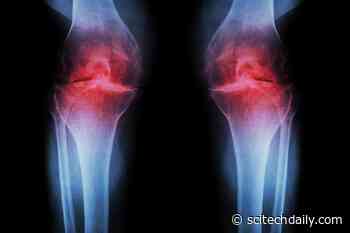 Scientists Discover Ultrasound May Stop Arthritis Before It Starts
