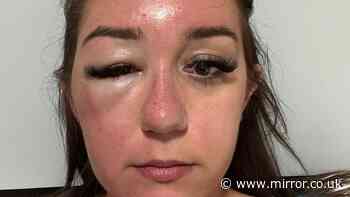 Woman trapped in Greece after developing 'eye bags' on holiday