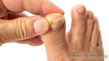 So many of us are struggling with embarrassing crusty, yellow toenails. This is the surprising habit that often triggers the problem - and exactly how to fix it: DR PHILIPPA KAYE