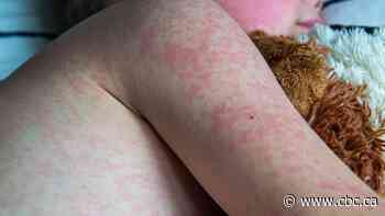 Manitoba measles cases drop in June as province remains national hotspot