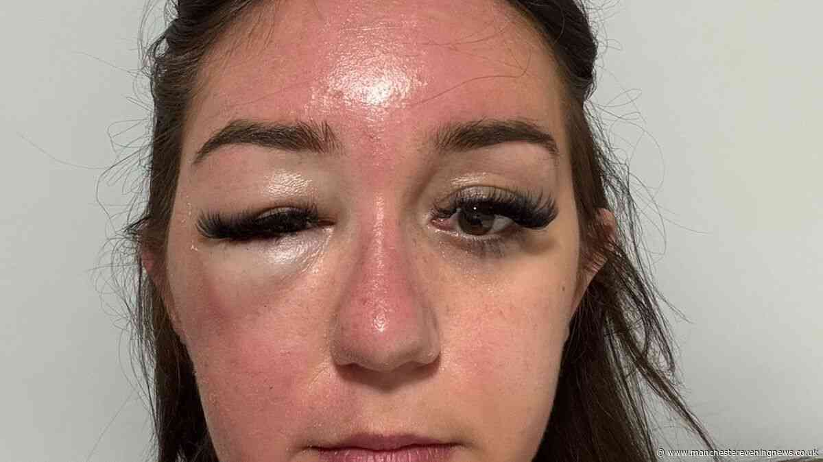 Brit holidaymaker's 'eye bags' lead to mystery illness trapping her in Greek hospital