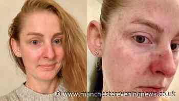 Rosacea sufferers praise clever cream that 'took redness from my face in days'