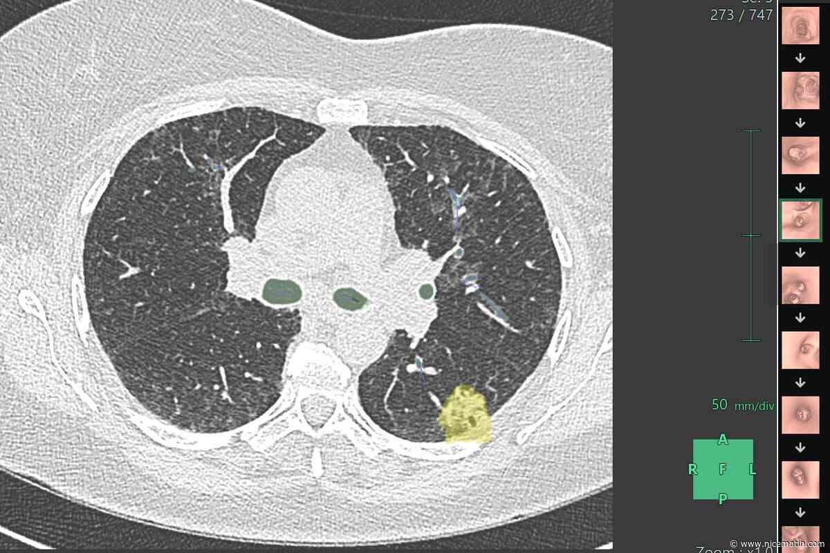 À Nice, un logiciel 3D guide les médecins au cœur des bronches
