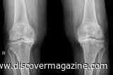 Osteoarthritis Could One Day Be Treated With a Single Regenerative Shot
