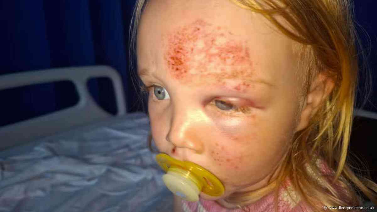 Toddler fractures skull during trip as nursery suspended