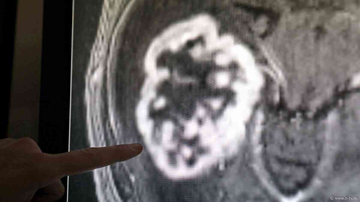 Trotz Fortschritts der Medizin: WHO warnt vor drastischem Anstieg von Krebs