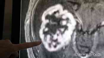 Trotz Fortschritts der Medizin: WHO warnt vor drastischem Anstieg von Krebs