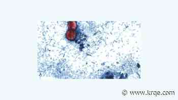 New Mexico Dept. of Health confirms three cases of diarrhea-causing parasite in state