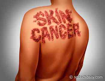 Scientists Discover 250+ Genes That Could Lead to New Ways To Prevent Melanoma