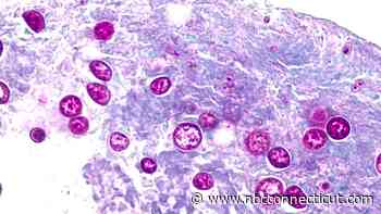 Connecticut reports 23 cases of cyclosporiasis as health officials urge produce washing
