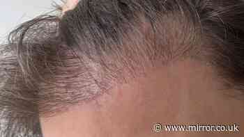 Turkey hair transplant ended up costing man £9,000 and years of misery