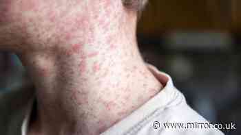 Measles death confirmed in UK as cases surge and vaccine drive launched