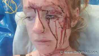 The bloodied face of school run mum severly injured in high speed smash with Rag n' Bone Man's wife - who's NEVER said sorry or shown remorse, say family