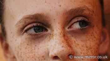 People only just realising what causes freckles and why they get darker