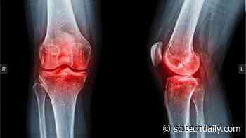 This Tiny-Bead Procedure Is Helping Patients Avoid Knee Replacement