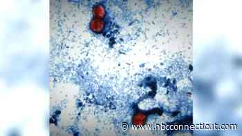35 cases of cyclosporiasis confirmed in Connecticut: DPH