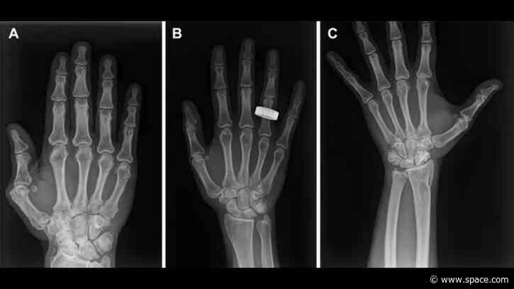 1st-ever X-rays in space offer hope for possible patients headed to the moon