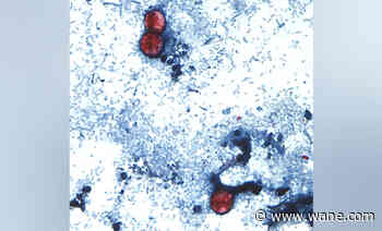 200+ cases of explosive diarrhea illness cyclosporiasis reported in Indiana