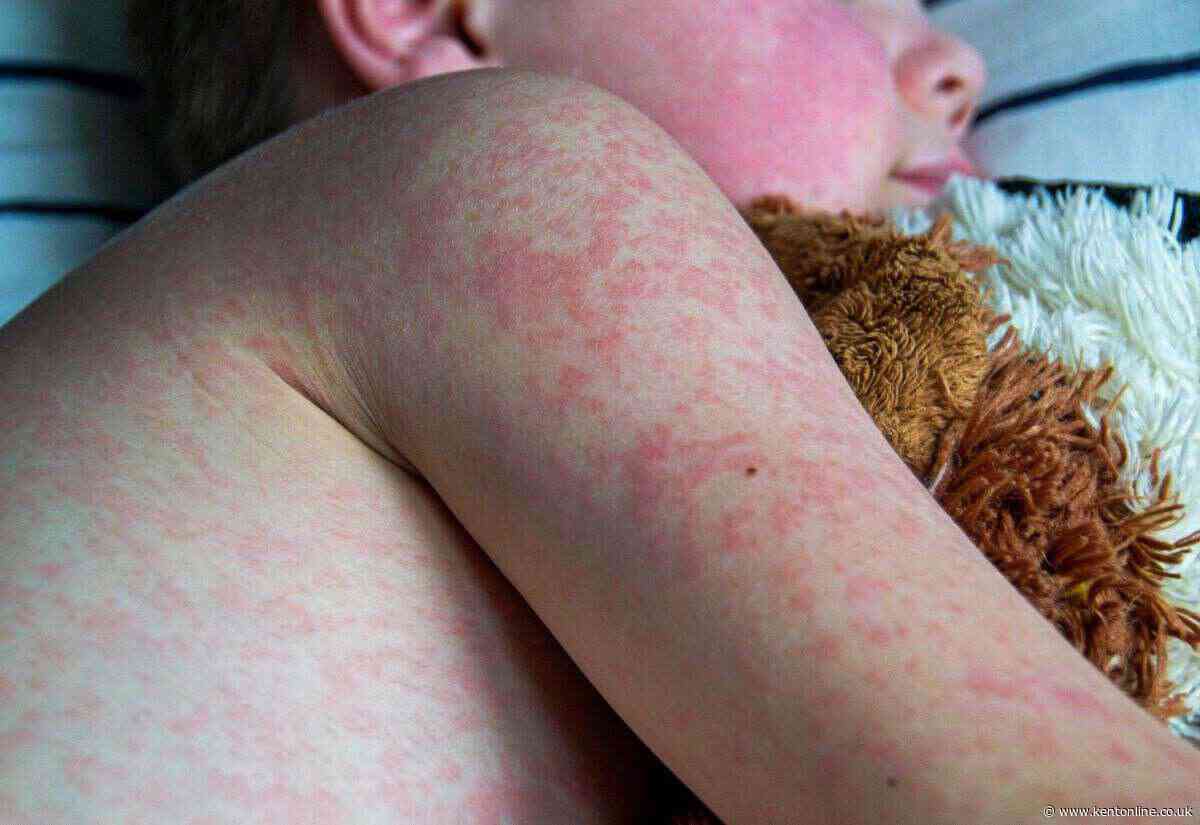 ‘It’s concerning’: Health bosses’ warning as nine new cases of measles recorded in Kent in July