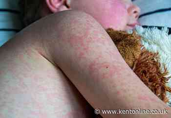 ‘It’s concerning’: Health bosses’ warning as nine new cases of measles recorded in Kent in July
