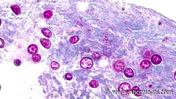 Cyclosporiasis cases in Florida, U.S. could be undercounted, experts say