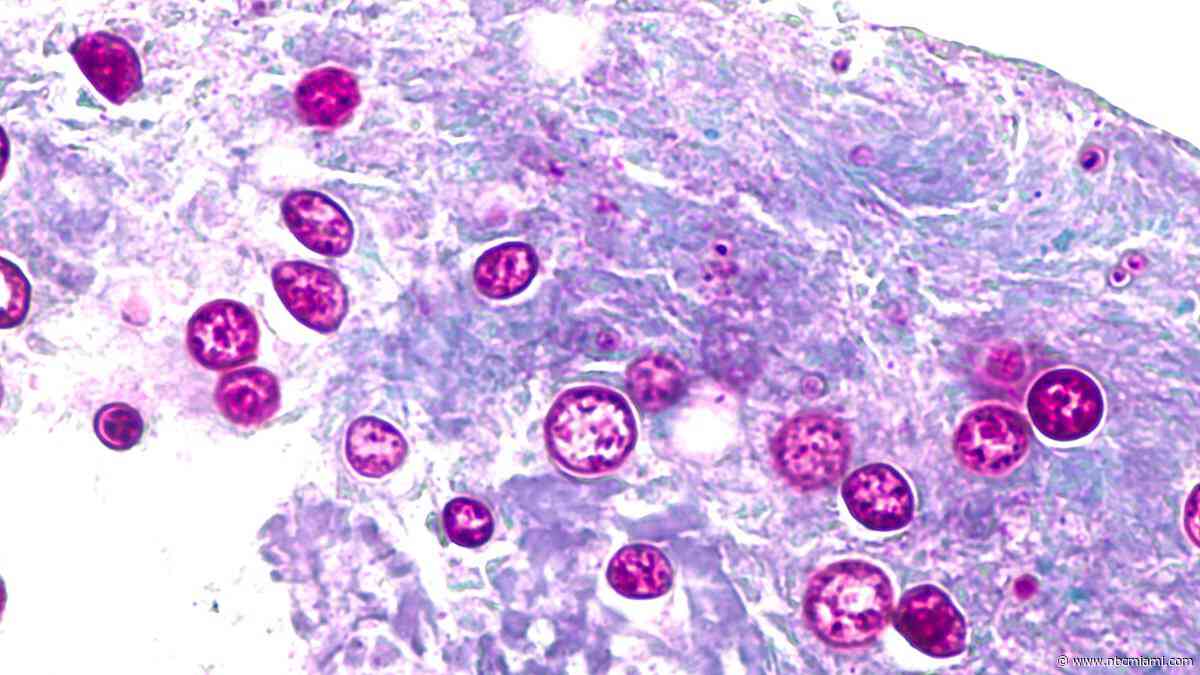 Cyclosporiasis cases in Florida, U.S. could be undercounted, experts say