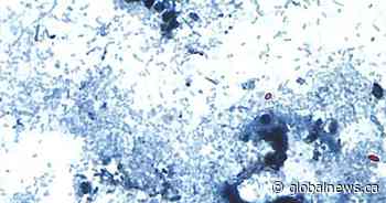 Where cyclosporiasis cases stand in Canada as U.S. parasite outbreak rages