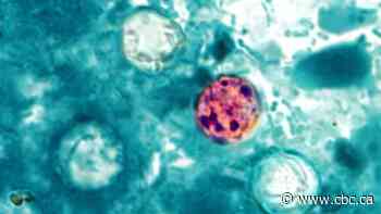 6 Albertans hit with parasitic illness, province says no link to U.S. outbreak found