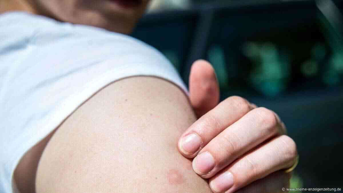 Von Spucke bis Salbe: Was hilft bei Mückenstichen?