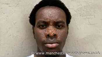 Rare skin condition leaves man, 21, with hundreds of tumours all over his face