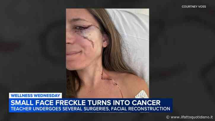 “Una lentiggine sul viso, poi la scoperta: era un melanoma. Il cancro alla pelle è una forma letale, fate prevenzione”: la storia di Courtney Voss