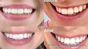 Tea drinker, 60, 'likes teeth' again after swapping whitening strips for £25 buy