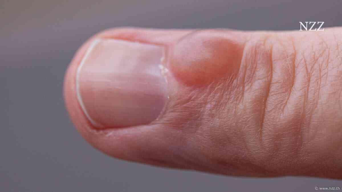 Warum eine Blase am Finger ein Fall für den Handchirurgen wurde