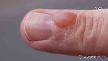 Warum eine Blase am Finger ein Fall für den Handchirurgen wurde