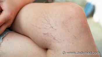 The DIY remedies for varicose veins that are too-often overlooked, according to top experts