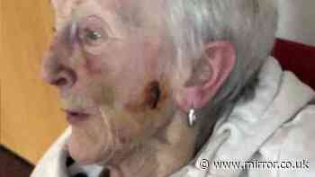 Daughter sickened to find vulnerable mum, 81, covered in bruises at care home
