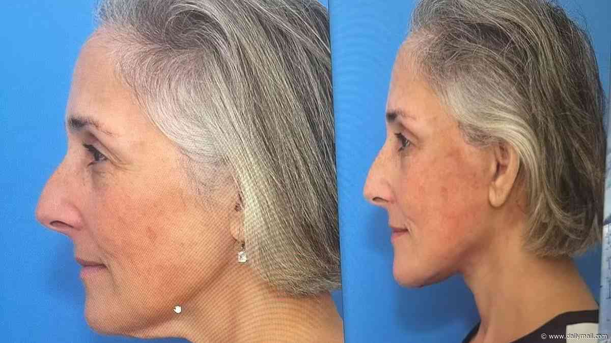 Ricki Lake, 57, shares shocking before-and-after facelift photos as she marks two-year anniversary of her plastic surgery procedure