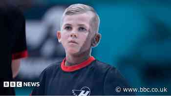 Birthmark no barrier for young footballing TV star