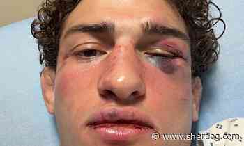 Austin Bashi reveals facial fractures following UFC OKC loss